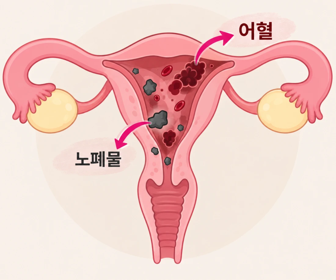 자궁 내 노폐물, 오로 배출 — 정상적인 배출로 자궁 건강을 지킵니다