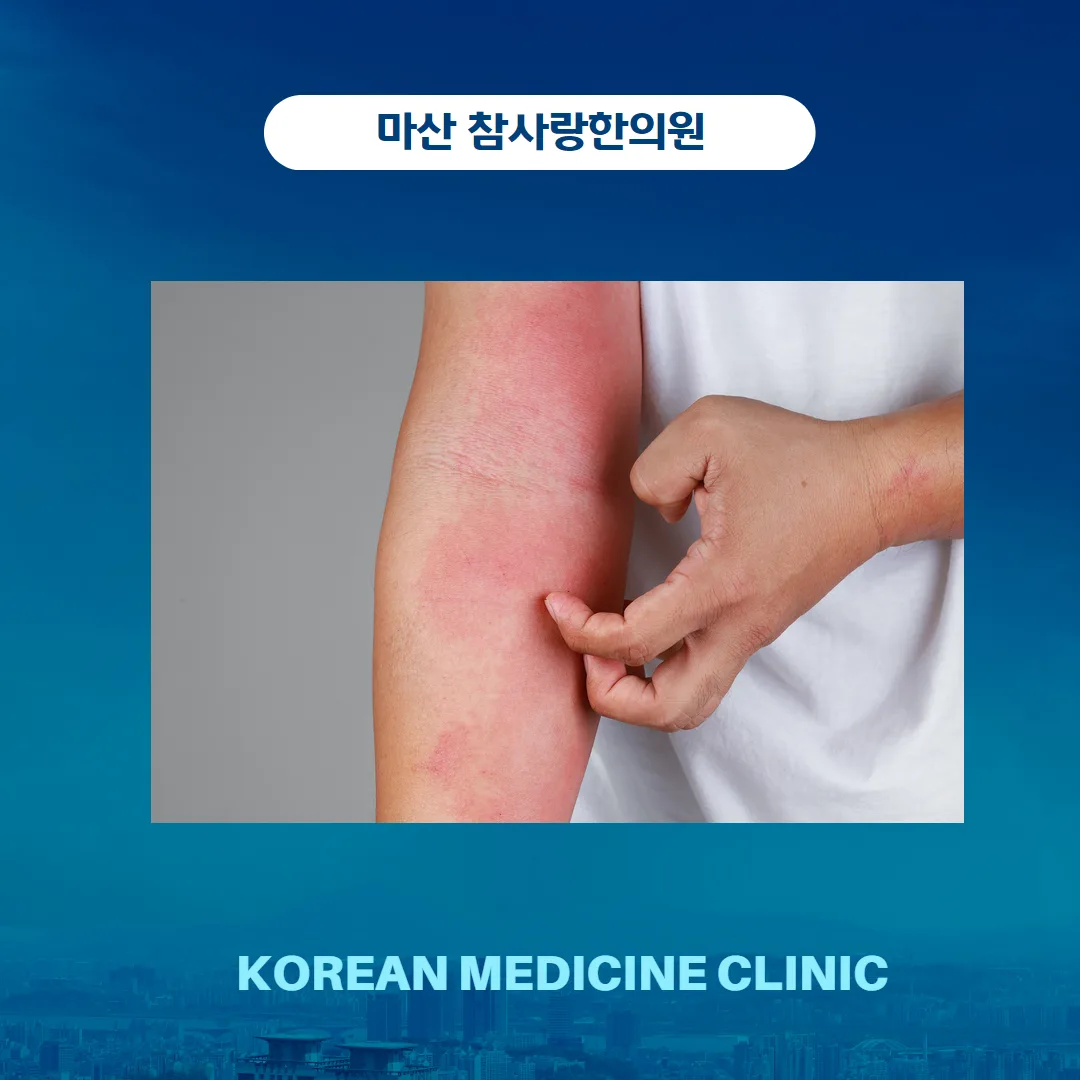 4. 건선의 치료법