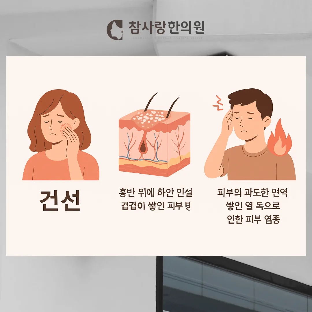 건선, 왜 반복될까요? 마산에서 찾는 한방 해법