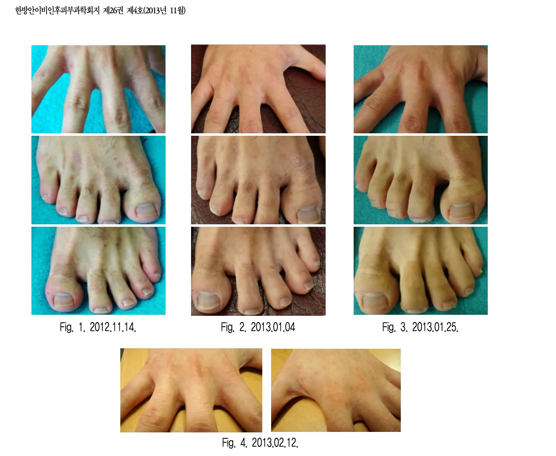 마산 한포진·창원 한포진, 반복되는 물집과 가려움의 한방 치료 이야기
