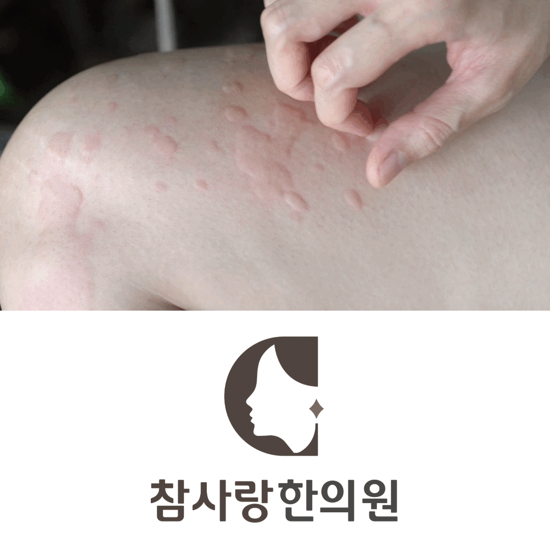 마산 두드러기, 반복되는 가려움과 발진의 원인을 찾다