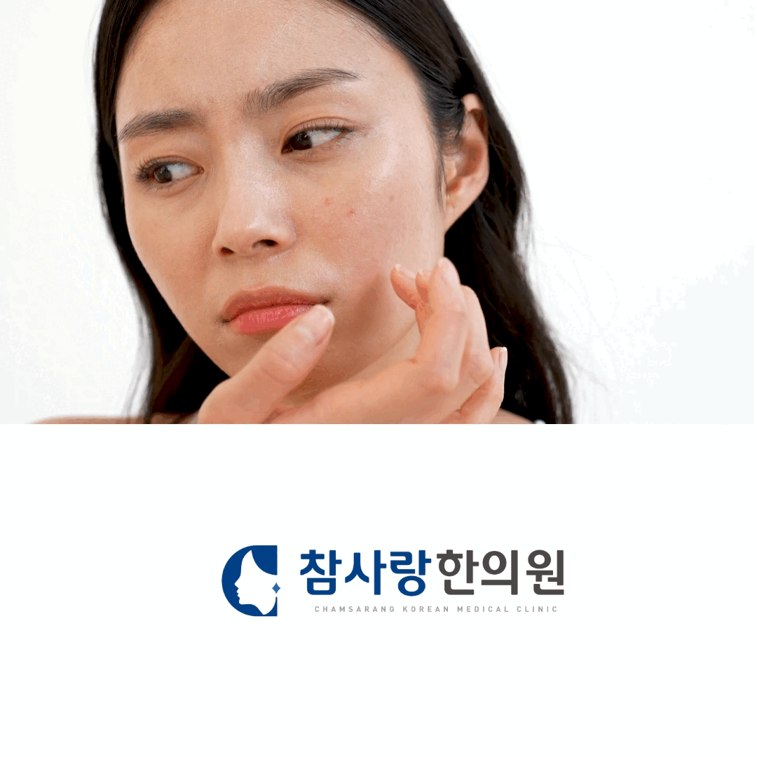 3. 간울화화(肝鬱化火): 스트레스로 간기가 울체되어 열로 바뀌고, 얼굴에 나타남