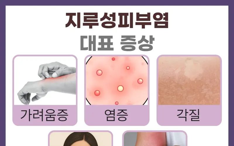 마산 지루성 피부염 치료, 체질에 따라 달라지는 접근법