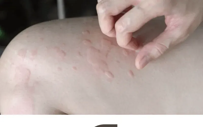 마산 두드러기, 반복되는 가려움과 발진의 원인을 찾다